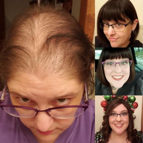 My Hair Loss Journey: Turning a Negative into a Positive, Written by @shannon2point0